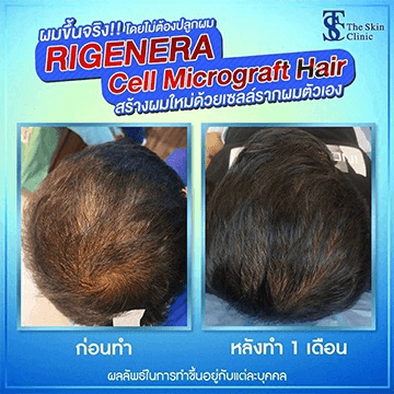 รีวิวหลังทำ Rigenera Cell Micrograft Hair 1 เดือน