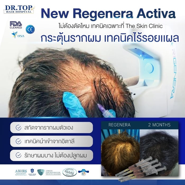 สร้างผมใหม่จากเซลล์รากผมของตัวเอง ช่วยแก้ปัญหาผมร่วงหนักมาก รากผมไม่แข็งแรง ทางเลือกสำหรับผู้ที่มีปัญหาผมร่วง ผมบาง แต่ไม่ต้องการปลูกผม เป็นการสกัด Growth Factor จากรากผมของคนไข้แล้วมาฉีดยังบริเวณหนังศีรษะที่มีปัญหา ช่วยลดผมหลุดร่วง กระตุ้นรากผม ทำให้เส้นผมหนาขึ้น