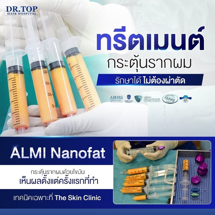 ทรีตเมนต์ผมหนาโดยไม่ต้องปลูกผม ที่ช่วยกระตุ้นและเสริมให้รากผมแข็งแรงด้วยการฉีดไขมันของคนไข้เอง ด้วยเทคนิค ALMI Nano Fat ช่วยเพิ่มประสิทธิภาพความแข็งแรงของเส้นผมที่เกิดใหม่ให้คงอยู่ได้นานและสมบูรณ์มากขึ้น