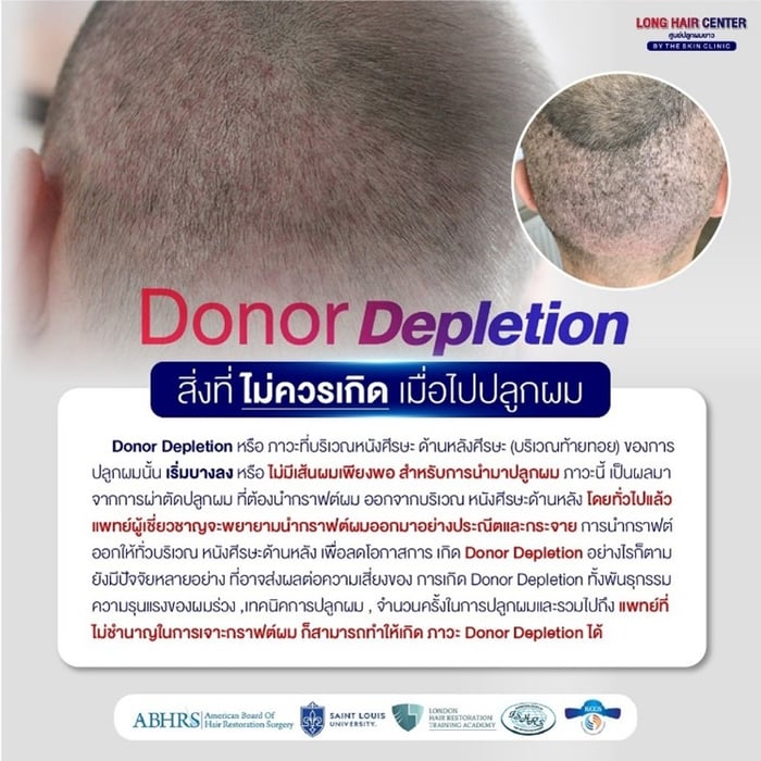 ปลูกผมที่ไหนดี, ศัลยกรรมปลูกผม