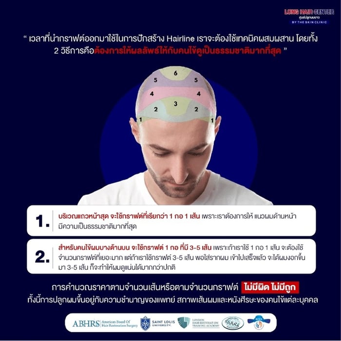 ปลูกผมต้องใช้กี่กราฟต์? ปัจจัยที่มีผลต่อการคำนวณกราฟต์ผม