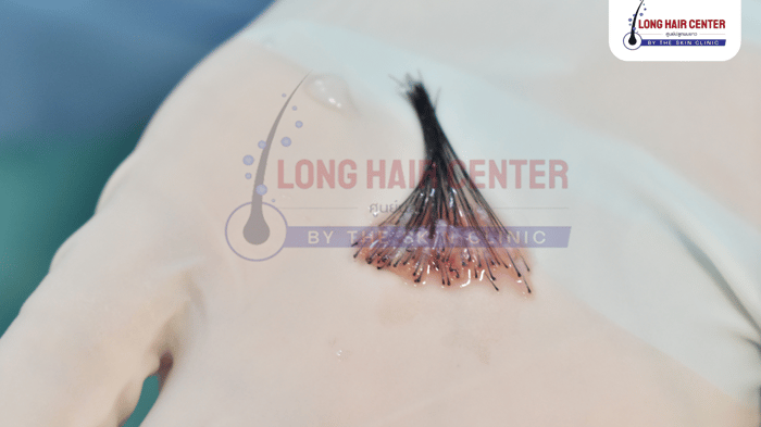 เทคนิคการเจาะกราฟต์ที่นิยมใช้ในการปลูกย้ายเซลล์รากผม