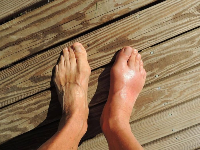 The Caregiver Guide - Managing Gout and Uric Acid Issues