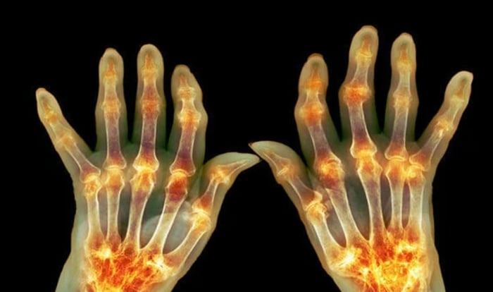 Hands with Arthritis: Health Benefits of Olive Oil