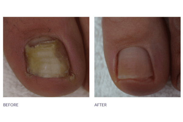 Nail Health Matters: Why Footlogix Nail Tincture Spray Belongs in Every Man’s Grooming Kit