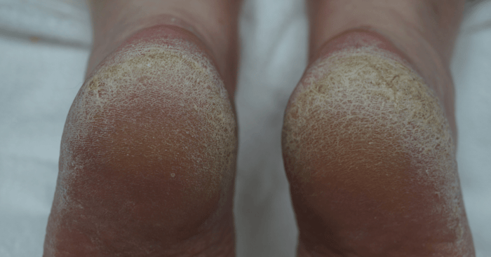 Step into Spring – How Hard Was Winter on Your Feet?