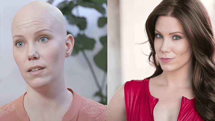 Jannica Olin sharing her valuable insights into her personal battle with alopecia. Photo shows her bald on the left, and wearing wig on the right.