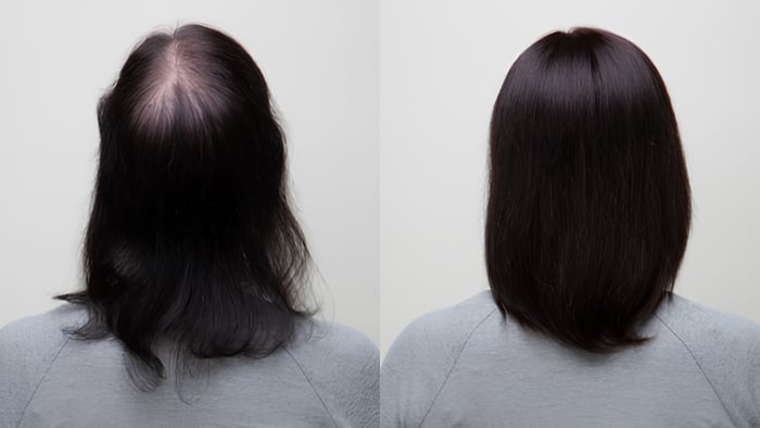 Woman with thinning crown vs wearing a hair topper.
