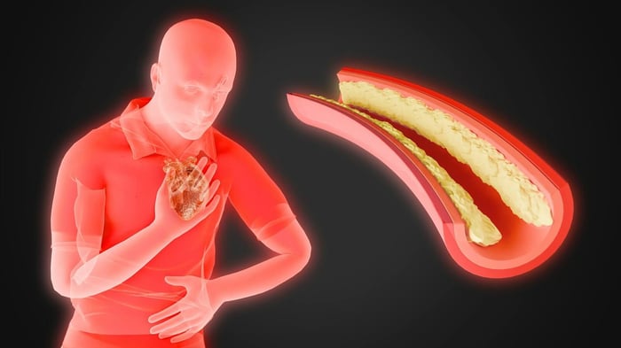 A graphic showing inflammation in the male human heart