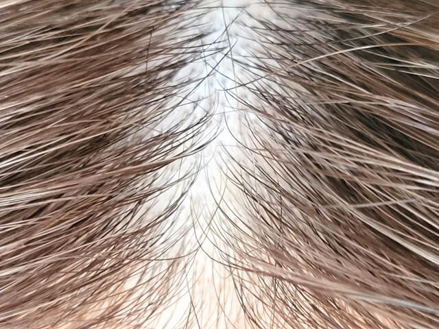 Our scalp ages 12 times faster than facial skin, showing signs like thinning hair, dryness, itchiness, and reduced hair growth.