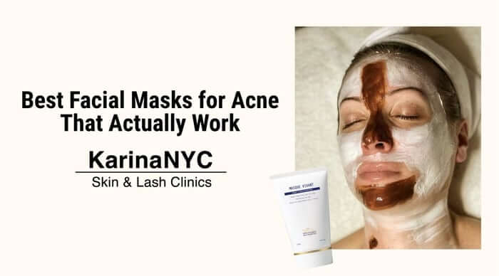 Best Facial Masks for Acne That Actually Work