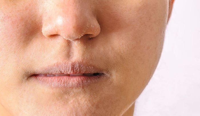 How Vitamin B Serum Transformed My Dry, Acne-Prone Skin This Winter