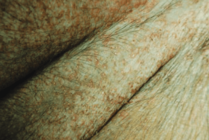 small white bumps on puppy with impetigo