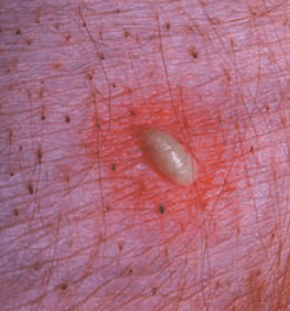 Raised white pustule in the skin of a dog pyoderma or bacterial infection