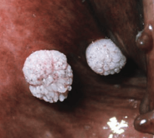 white bumps with cauliflower look from dog warts in mouth