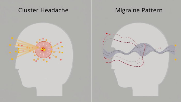 Illustration comparing cluster headache vs migraine symptom patterns over time