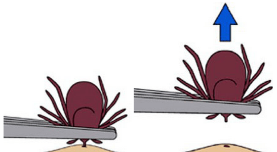 tickremoval.png