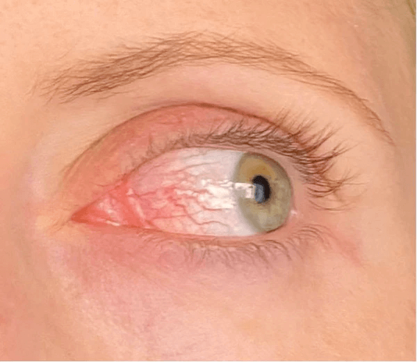 Latisse Side Effects conjunctival hyperemia