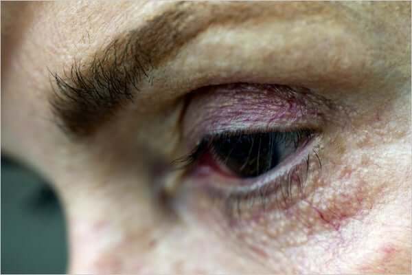 latisse-side-effects-nyt