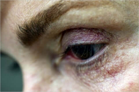latisse-eyelid-darkening
