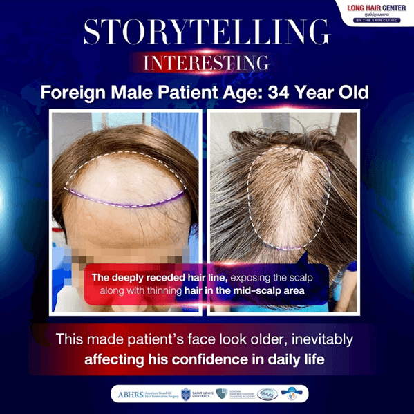 Hair Transplant in Thailand Review: German Patient’s with Long Hair FUI by Dr. Top Hair Hospital