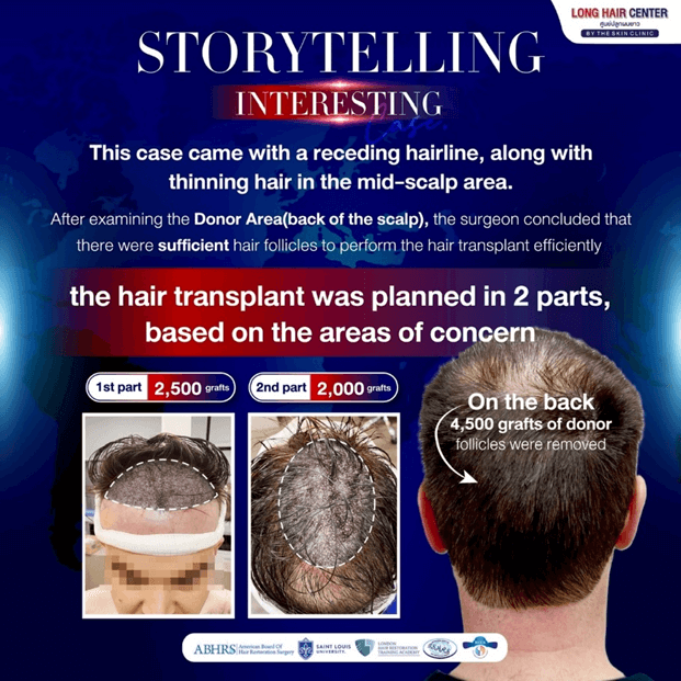 Hair Transplant in Thailand Review: German Patient’s with Long Hair FUI by Dr. Top Hair Hospital