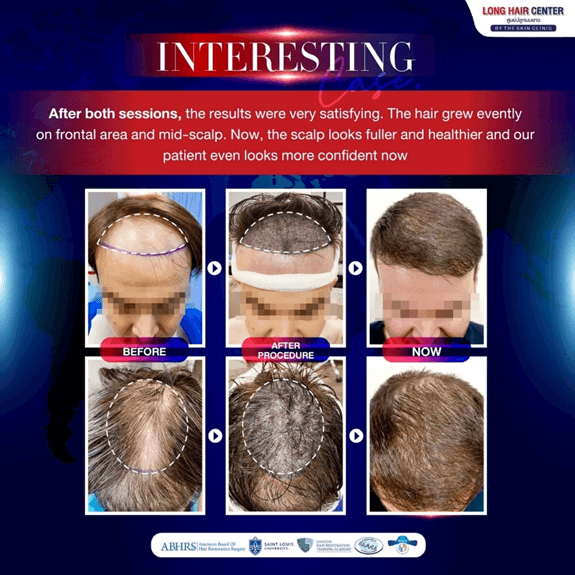 Hair Transplant in Thailand Review: German Patient’s with Long Hair FUI by Dr. Top Hair Hospital