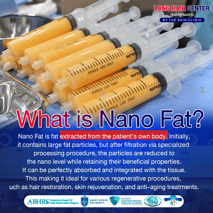 Using one’s own fat to restore hair, known as Nano Fat, is a groundbreaking innovation in the hair transplantation field that has gained significant attention. It delivers visible results with a high level of safety. This article will take you deeper into everything about Nano Fat. An appealing option for those facing hair loss or thinning. While uncovering why Nano Fat has become a key factor in enhancing the effectiveness of hair transplantation.