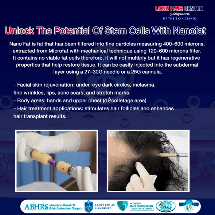 Using one’s own fat to restore hair, known as Nano Fat, is a groundbreaking innovation in the hair transplantation field that has gained significant attention. It delivers visible results with a high level of safety. This article will take you deeper into everything about Nano Fat. An appealing option for those facing hair loss or thinning. While uncovering why Nano Fat has become a key factor in enhancing the effectiveness of hair transplantation.