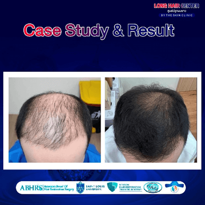 Using one’s own fat to restore hair, known as Nano Fat, is a groundbreaking innovation in the hair transplantation field that has gained significant attention. It delivers visible results with a high level of safety. This article will take you deeper into everything about Nano Fat. An appealing option for those facing hair loss or thinning. While uncovering why Nano Fat has become a key factor in enhancing the effectiveness of hair transplantation.