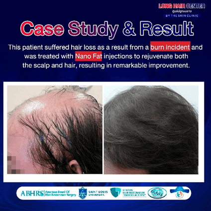 Using one’s own fat to restore hair, known as Nano Fat, is a groundbreaking innovation in the hair transplantation field that has gained significant attention. It delivers visible results with a high level of safety. This article will take you deeper into everything about Nano Fat. An appealing option for those facing hair loss or thinning. While uncovering why Nano Fat has become a key factor in enhancing the effectiveness of hair transplantation.