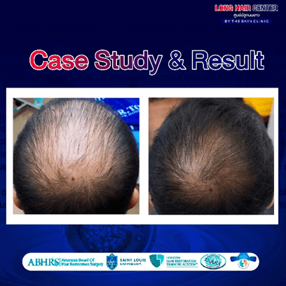Using one’s own fat to restore hair, known as Nano Fat, is a groundbreaking innovation in the hair transplantation field that has gained significant attention. It delivers visible results with a high level of safety. This article will take you deeper into everything about Nano Fat. An appealing option for those facing hair loss or thinning. While uncovering why Nano Fat has become a key factor in enhancing the effectiveness of hair transplantation.