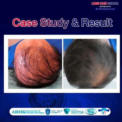 Using one’s own fat to restore hair, known as Nano Fat, is a groundbreaking innovation in the hair transplantation field that has gained significant attention. It delivers visible results with a high level of safety. This article will take you deeper into everything about Nano Fat. An appealing option for those facing hair loss or thinning. While uncovering why Nano Fat has become a key factor in enhancing the effectiveness of hair transplantation.
