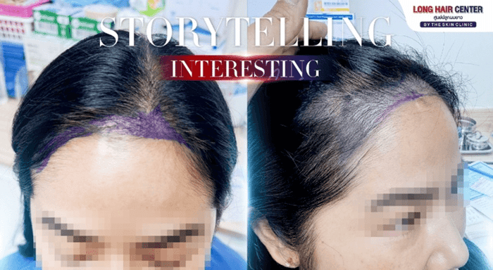 Hair Transplant for Women on the Existing Hairline, harder Than You Think