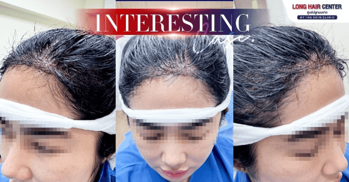 Hair Transplant for Women on the Existing Hairline, harder Than You Think