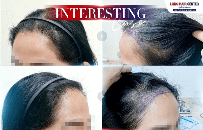 Hair Transplant for Women on the Existing Hairline, harder Than You Think