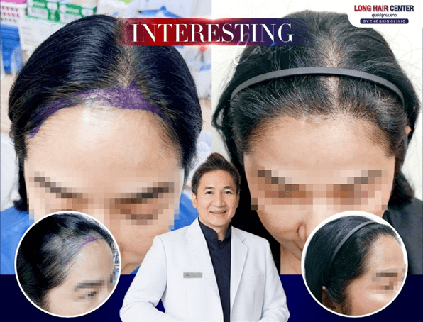 Hair Transplant for Women on the Existing Hairline, harder Than You Think