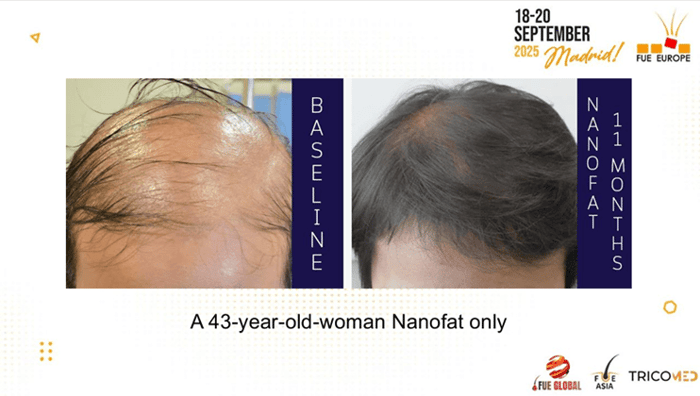 Case studies that Dr. Top presented at the 13th FUE EUROPE 2025 conference