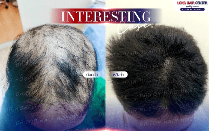 Case studies that Dr. Top presented at the 13th FUE EUROPE 2025 conference