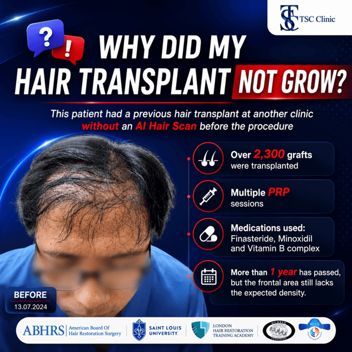 A summerized banner on the subject "Why did my hair transplant not grow?"
