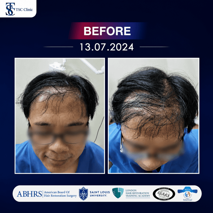 A "Before" image showing a person with less hair growth on his forehead