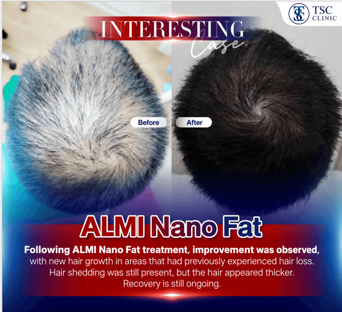 Following ALMI Nano Fat treatment, improvement was observed, with new hair growth in areas that had previously experienced hair loss. Hair shedding was still present, but the hair appeared thicker. Recovery is still ongoing.