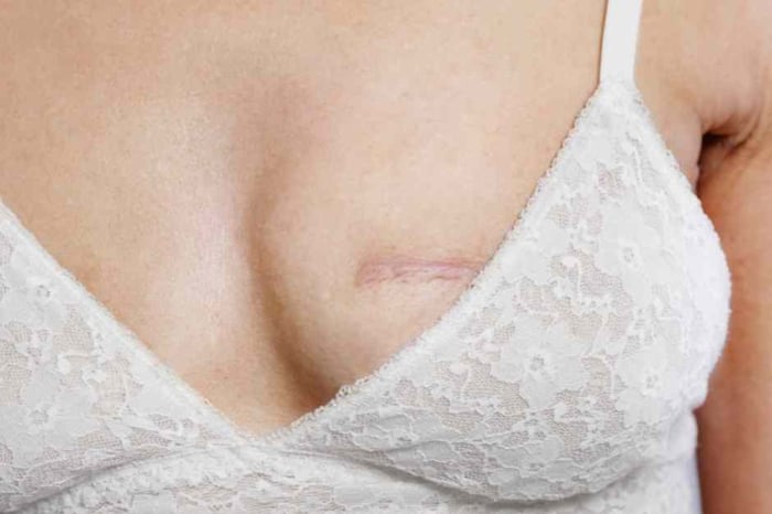 What to Wear After Lumpectomy Surgery for Better Shape