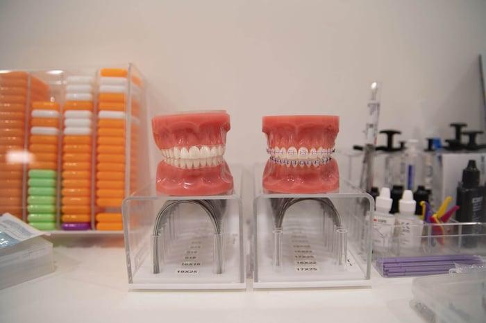Dental models showing teeth with and without braces used for orthodontic education and treatment planning.