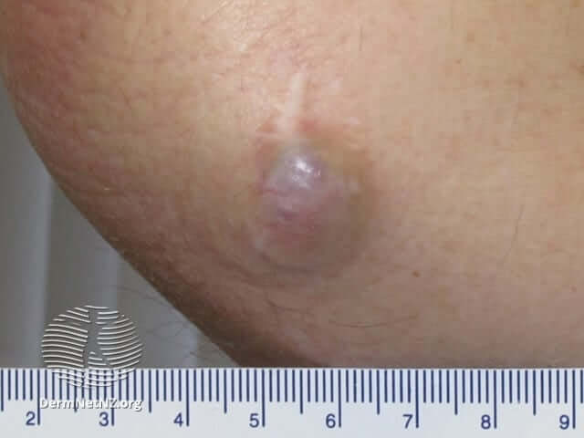 Skin Cancer Images - AIM at Skin Cancer Foundation Skin Cancer Images - AIM at Skin Cancer Foundation