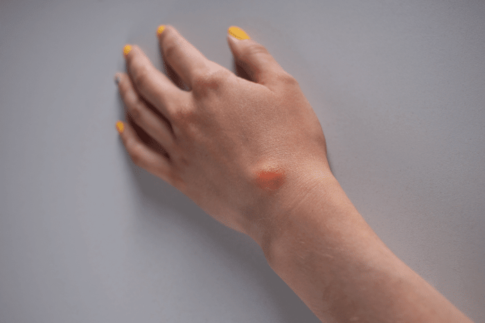 Cystic Cyst | Causes, Signs, Symptoms, Diagnoses, Treatments Cystic Cyst | Causes, Signs, Symptoms, Diagnoses, Treatments