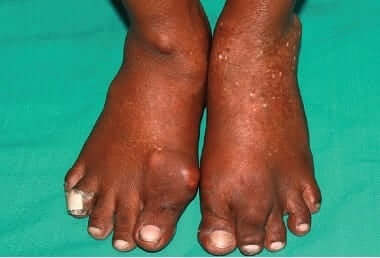 Gout Tophi Bump On Top Of Foot: Causes, Symptoms & Treatment Gout Tophi Bump On Top Of Foot: Causes, Symptoms & Treatment