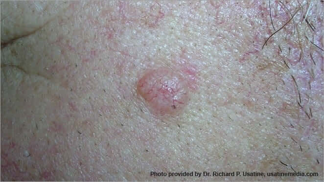 Skin Cancer Pictures | Skin Cancer Images | What Does Skin Cancer Look Like? | American Cancer Society Skin Cancer Pictures | Skin Cancer Images | What Does Skin Cancer Look Like? | American Cancer Society