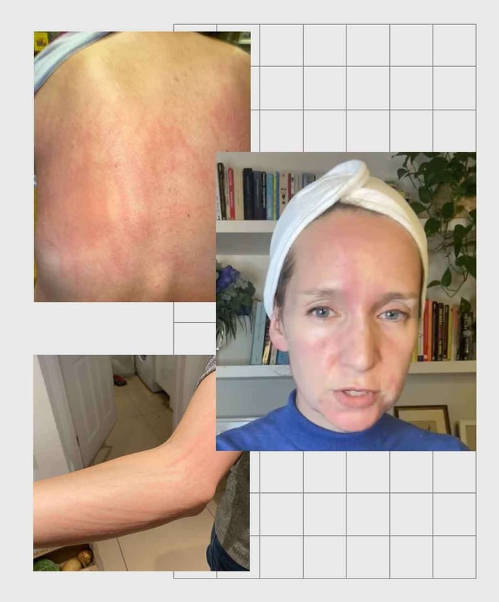 Woman showing chronic hives (urticaria) on face and arms with visible red raised welts on sensitive skin