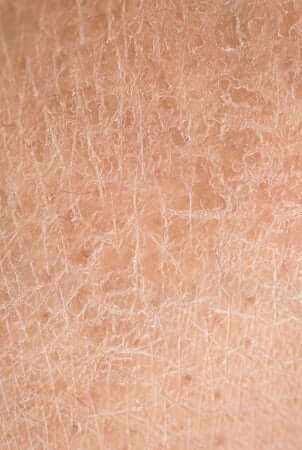 Close-up texture of dry flaky skin showing white patches and rough surface